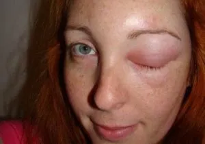 Umflarea alergii ochi - ce să facă