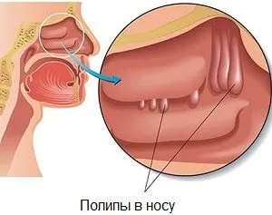 Umflarea mucoasei nazale fara cauze rinita si tratamentul sinusurilor