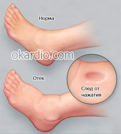 umflarea picioarelor din cauze de insuficienta cardiaca, simptome, tratament (motive) umflarea picioarelor din cauze de insuficienta cardiaca, simptome, tratament