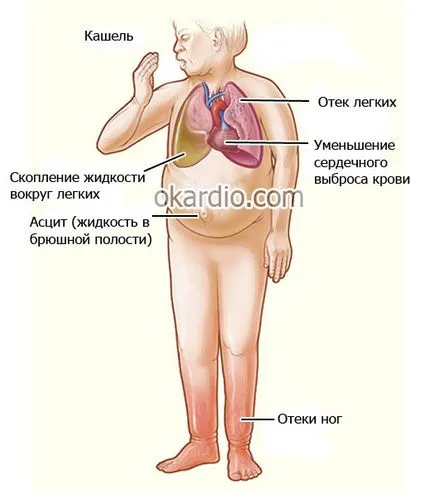umflarea picioarelor din cauze de insuficienta cardiaca, simptome, tratament (insuficiență) umflarea picioarelor din cauze de insuficienta cardiaca, simptome, tratament