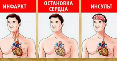 Primele semne de atac și de accident vascular cerebral simptome cardiace și precursori pentru femei și bărbați