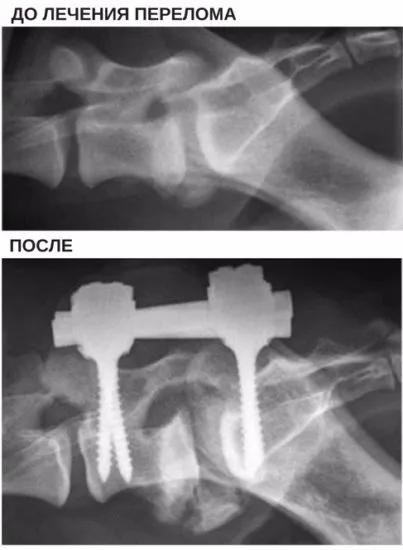 Fractura a coloanei vertebrale de pisica si simptomele pisicii, tipul de compresie, tratament, cum de a restabili (pisica) fractură a coloanei vertebrale de pisica si simptomele pisicii, tipul de compresie, tratament, cum de a recupera