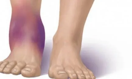 picioare Fracture care fac, simptome și tratament (semne picioare rupte) picioare Fracture ce să facă, simptome și tratament
