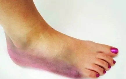 picioare Fracture ce să facă, simptome și tratament (după ruperea piciorul este umflat) picioare Fracture ce să facă, simptome și tratament