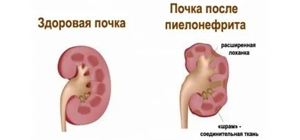 Simptome renale de presiune, tratamente, și cum de a reduce