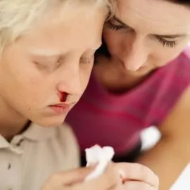 De ce este sângerarea din nas și cum de a opri medicația, simptomele, cauzele de epistaxis (sânge) De ce este sângerarea din nas și cum de a opri medicația, simptomele, cauzele de epistaxis