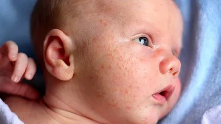 De ce este o alergie la sugari, simptome, metode de tratament si prevenire