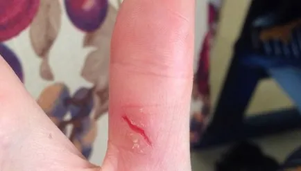 De ce este pielea uscată și crăpată de pe mâini, boli de piele