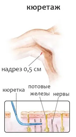 Cauzele underarm transpirație, cum să scape, revizuirea preparatelor farmaceutice (cauza) Cauzele underarm transpirație, cum să scape, revizuirea preparatelor farmaceutice