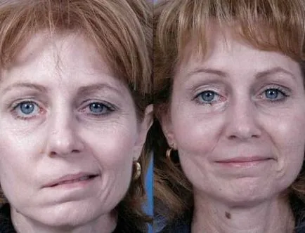 Consecințele dreapta accident vascular cerebral hemoragic și stângă ale creierului