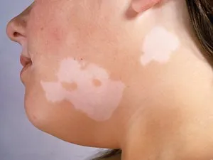 Apariția unor pete albe pe piele a ceea ce este, cum să trateze pete luminoase pe partea din spate și corp fotografie (la fața locului a corpului este de culoare albă care apare pielea foto trata un punct de lumină din spate) Apariția unor pete albe pe piele a ceea ce este, cum să trateze petele luminoase de pe spate și fotografii ale corpului