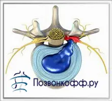 Motivele pentru apariția și dezvoltarea herniei vertebrale