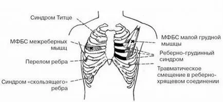 Cauze, simptome si tratamentul sindromului Tietze (costale chondrite) Fotografii de pacienți (tratamentul sindromului Tietze lui) Cauze, simptome si tratamentul sindromului Tietze (costale chondrite) fotografii ale pacienților