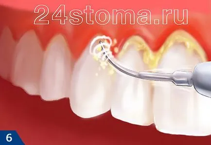 igienizarea profesională a dinților - cum ar trebui să fie, prețul (de curățare profesională a dinților) curățare profesională a dinților - cum ar trebui să fie, prețul