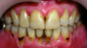 remedii populare verificate pentru tratamentul periodontitei (ajustat cu apă clocotită) remedii tradiționale dovedită pentru tratamentul parodontitei