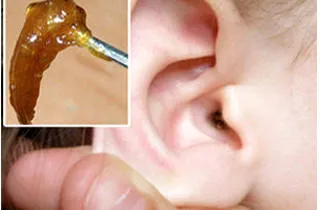 Spalarea urechea de cerumen - precum și ceea ce pot pentru a curăța (poate fi) Spalarea urechea de cerumen - cum și ce acestea pot fi curățate