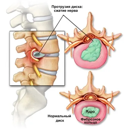 Proeminența coloanei vertebrale lombare cauze, simptome si tratament (iesire) Proeminența cauze coloanei vertebrale lombare, simptome și tratament