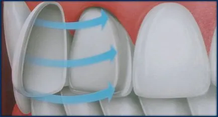 Protetica dinți din față - toate tipurile de proteze pentru dinții anteriori