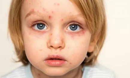 Prevenirea varicela, dar varicela bolnav în contact cu pacientul