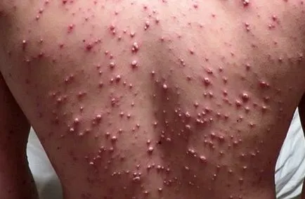 Prevenirea varicela, dar varicela bolnav în contact cu pacientul