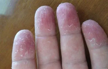 mâinile psoriazis imaginat și tratamentul eficient al simptomelor de unguente (psoriazis) Psoriazisul pe mâinile foto, simptomele și unguentele eficiente de tratament