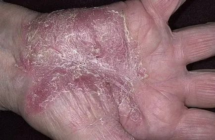 Psoriazisul pe mâini etapa inițială - în brațe de tratament psoriazis (mâini) Psoriazisul pe mâinile în stadiu inițial - psoriazis pe tratamentul lui mâini
