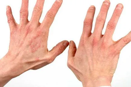 Psoriazisul pe mâini etapa inițială - în brațe de tratament psoriazis (mâini) Psoriazisul pe mâinile în stadiu inițial - psoriazis pe tratamentul lui mâini