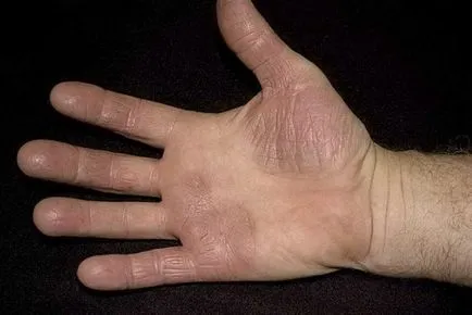Psoriazisul pe mâinile fotografie, simptomele și unguent eficace de tratament (tratament) Psoriazisul pe mâinile foto, simptomele și unguentele eficiente de tratament