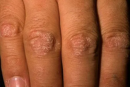 Psoriazisul pe mâinile foto, simptomele și unguentele eficiente de tratament (foto) Psoriazisul pe mâinile foto, simptomele și unguentele eficiente de tratament