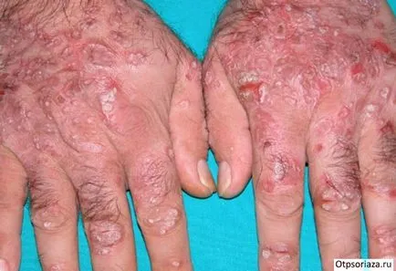 Psoriazisul pe mâinile fotografiei, etapa, tratarea și cauzele
