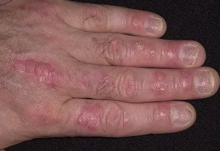 Psoriazisul pe mâini etapă inițială - pentru tratamentul psoriazisului brațelor (etapa) Psoriazisul pe mâinile în stadiu inițial - psoriazis pe tratamentul lui mâini