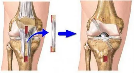 semne de ruptura incrucisat anterior ligament, tratament, reabilitare (liant) semne frontali ruptura ligamentului incrucisat, tratament, reabilitare