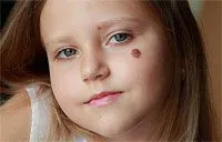 Alunițele la copii