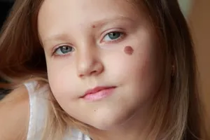 Alunitele atunci când există copii, cauzele (mol) Alunitele atunci când există copii, motivele