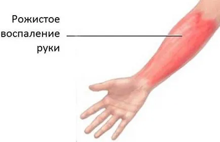 Erizipel simptome mâini și tratamentul erizipel mâini de remedii populare