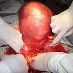 sarcom uterin - simptome, tratament, prognostic