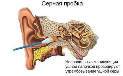 Cerumen în ureche - ce să facă, cum să-l eliminați