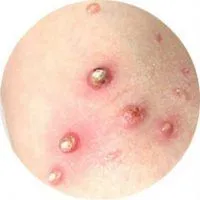 Simptomele Molluscum contagiosum pielii, tratamentul acesteia (simptome) Simptomele Molluscum contagiosum pielii, tratament