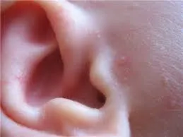 Rashes pe urechi cauze, diagnostic, tratament