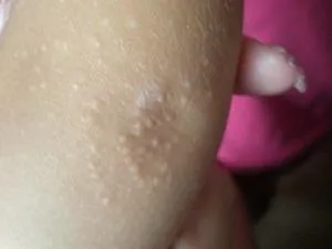 Erupții cutanate pe coate