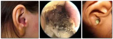 Simptome de cerumen Preparate pentru urechi, remedii de tratament populare