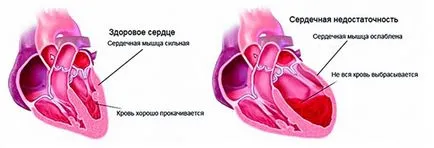 Simptomele de insuficiență cardiacă, acută și cronică la femei