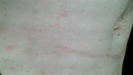 Erupții cutanate pe abdomen foto, motive, descrieri, boli de piele