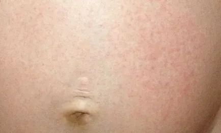 Erupții cutanate pe abdomen foto, motive, descrieri, boli de piele
