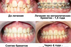 Cât timp ar trebui să poarte aparat dentar (uzura) Cât timp ar trebui să poarte aparat dentar