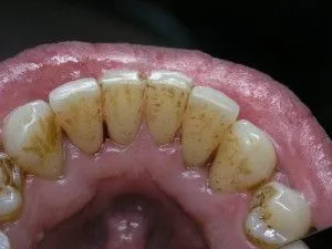 Care este costul pentru a elimina tartrului în stomatologie (dentare) Care este costul pentru a elimina tartrului în stomatologie