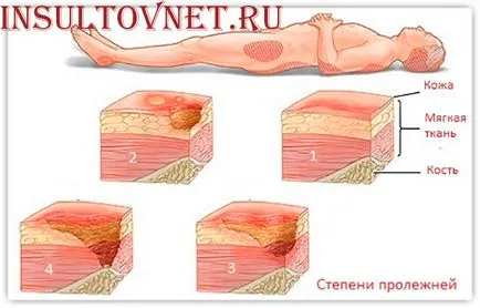 Moartea ca urmare a accident vascular cerebral - realitate sau speculații