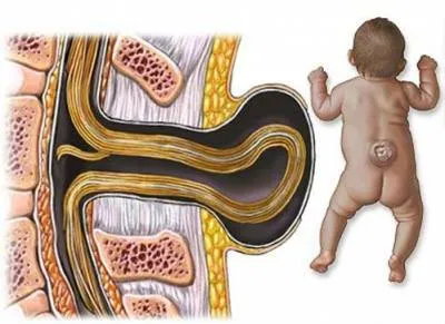 Tratamentul coloanei vertebrale hernie și îndepărtarea, tipuri și cauze, diagnostic