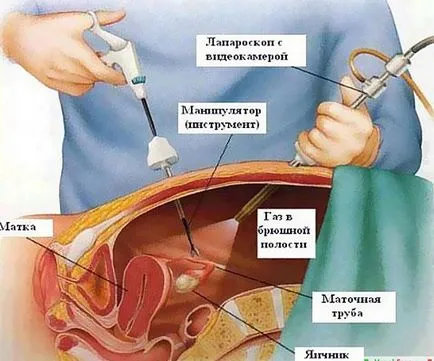 Adeziuni pe ovare de ce trebuie să fie tratate în timp util