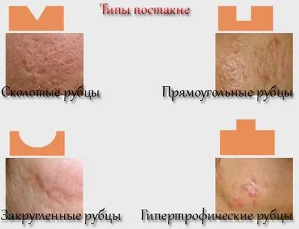 Remediu pentru acnee cicatrici (cicatrici) - cel mai bun acasă, de la pete, populare, eficiente (mijloace) Remediu pentru acnee cicatrici (cicatrici) - cel mai bun acasă, de la pete, folk, eficient